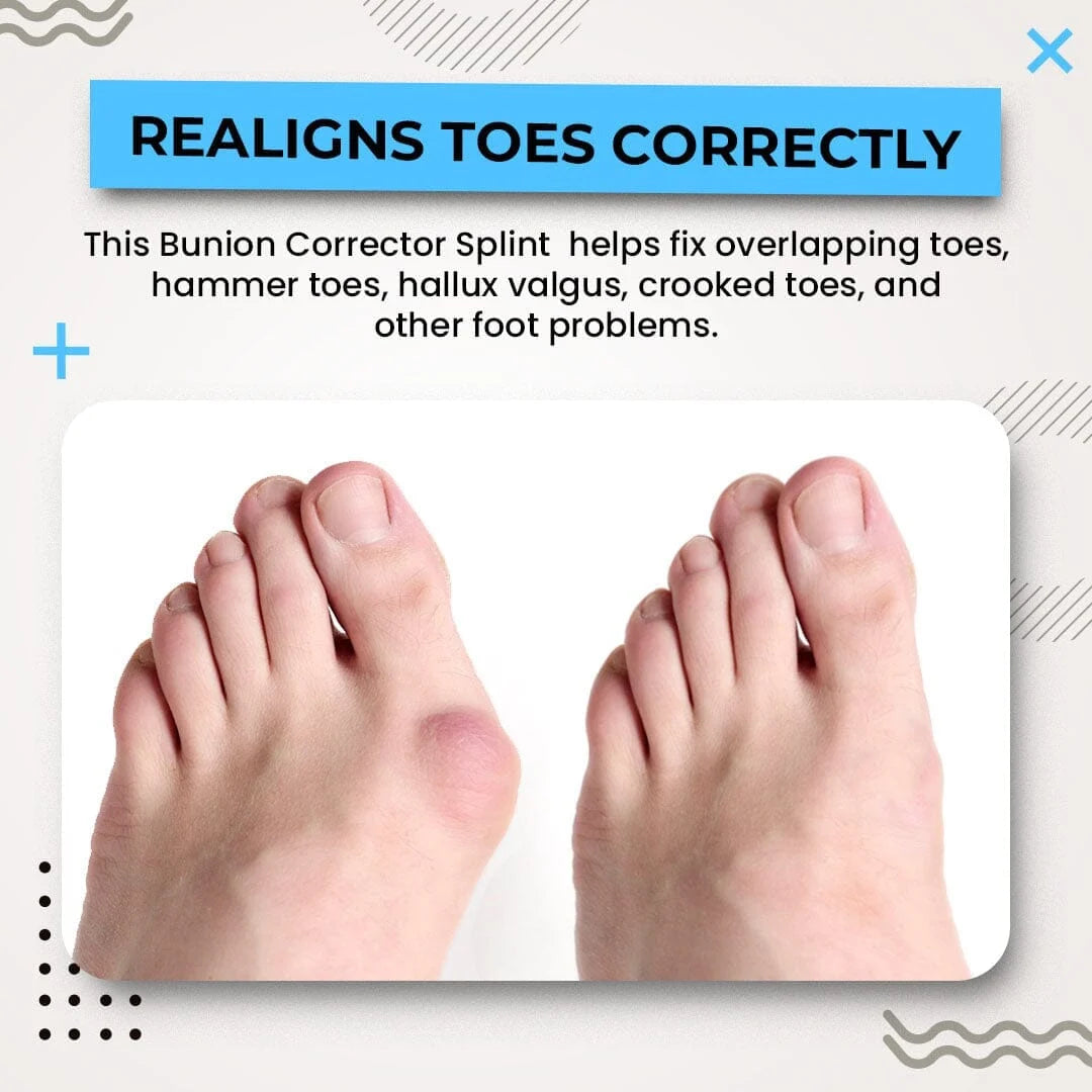 3D Bunion Splint Corrector